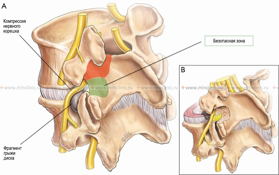 Inter-articular endoscopic operative access to the foraminal and extraforaminal fragment of the herniated intervertebral disc, which compresses the nerve root.